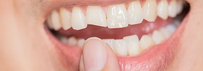 4 Steps to Take If You Have a Cracked Tooth