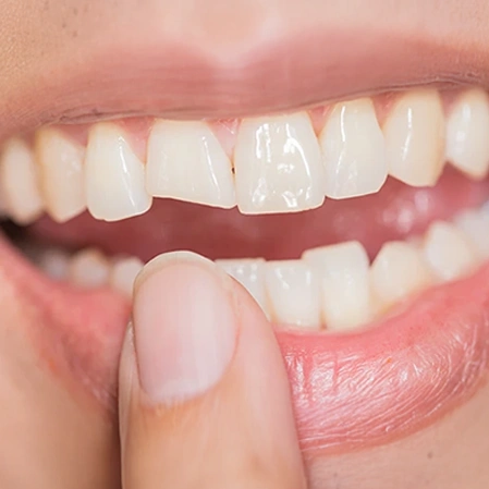 Finger Pointing To A Broken Front Tooth